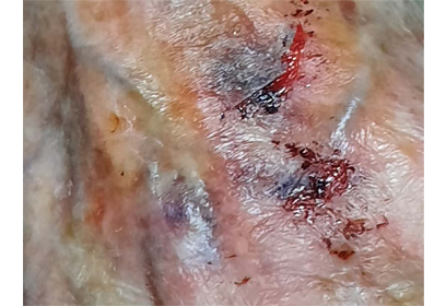 Skin Tears Behandlung Tag 0