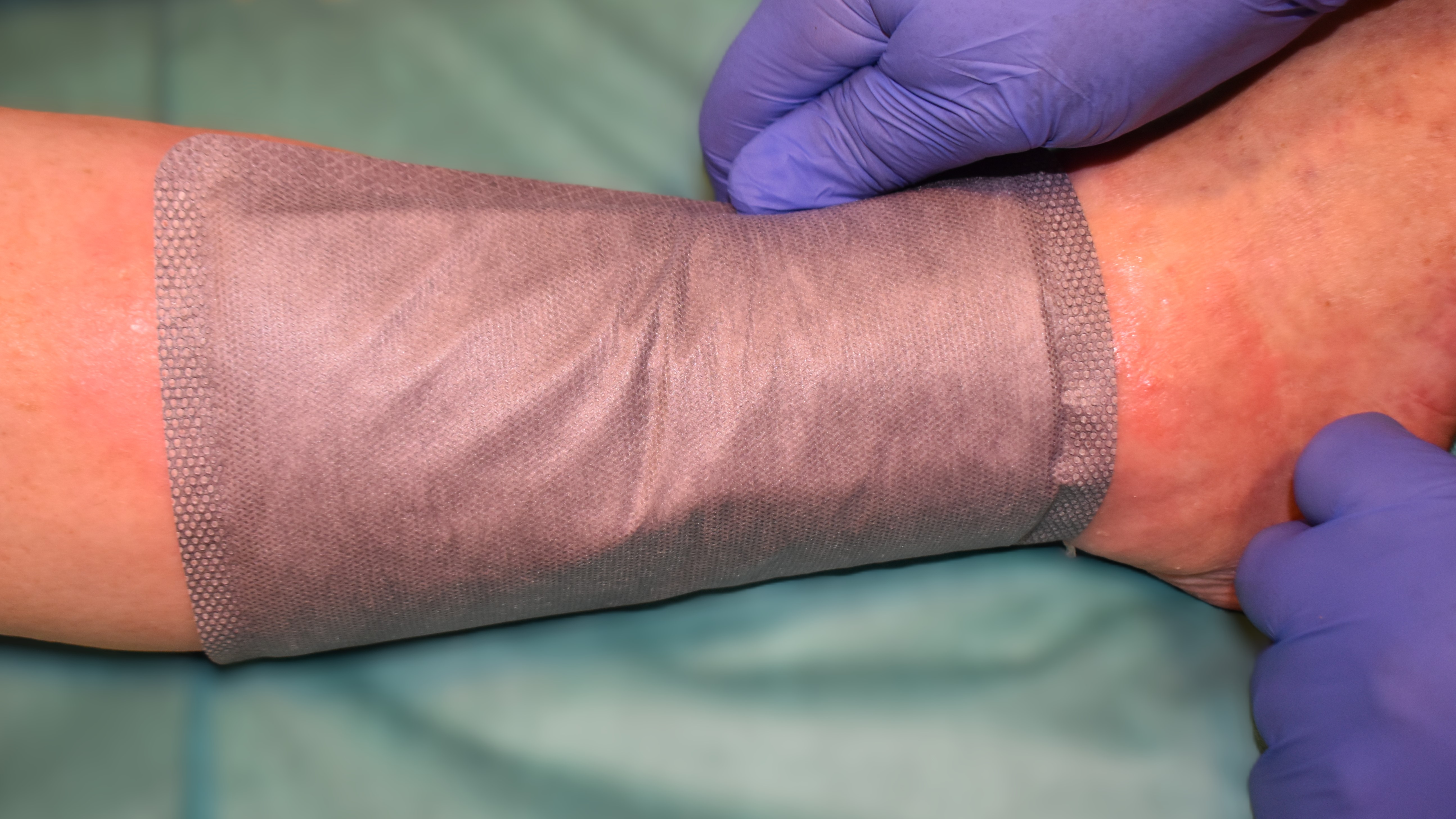 Anwendung des Biatain Superabsorber