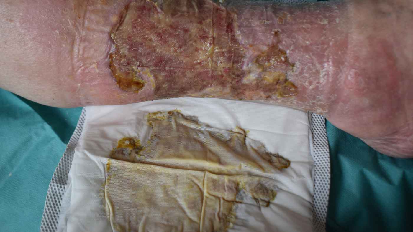 Verbandwechsel nach 3 Tagen des Biatain Superabsorber