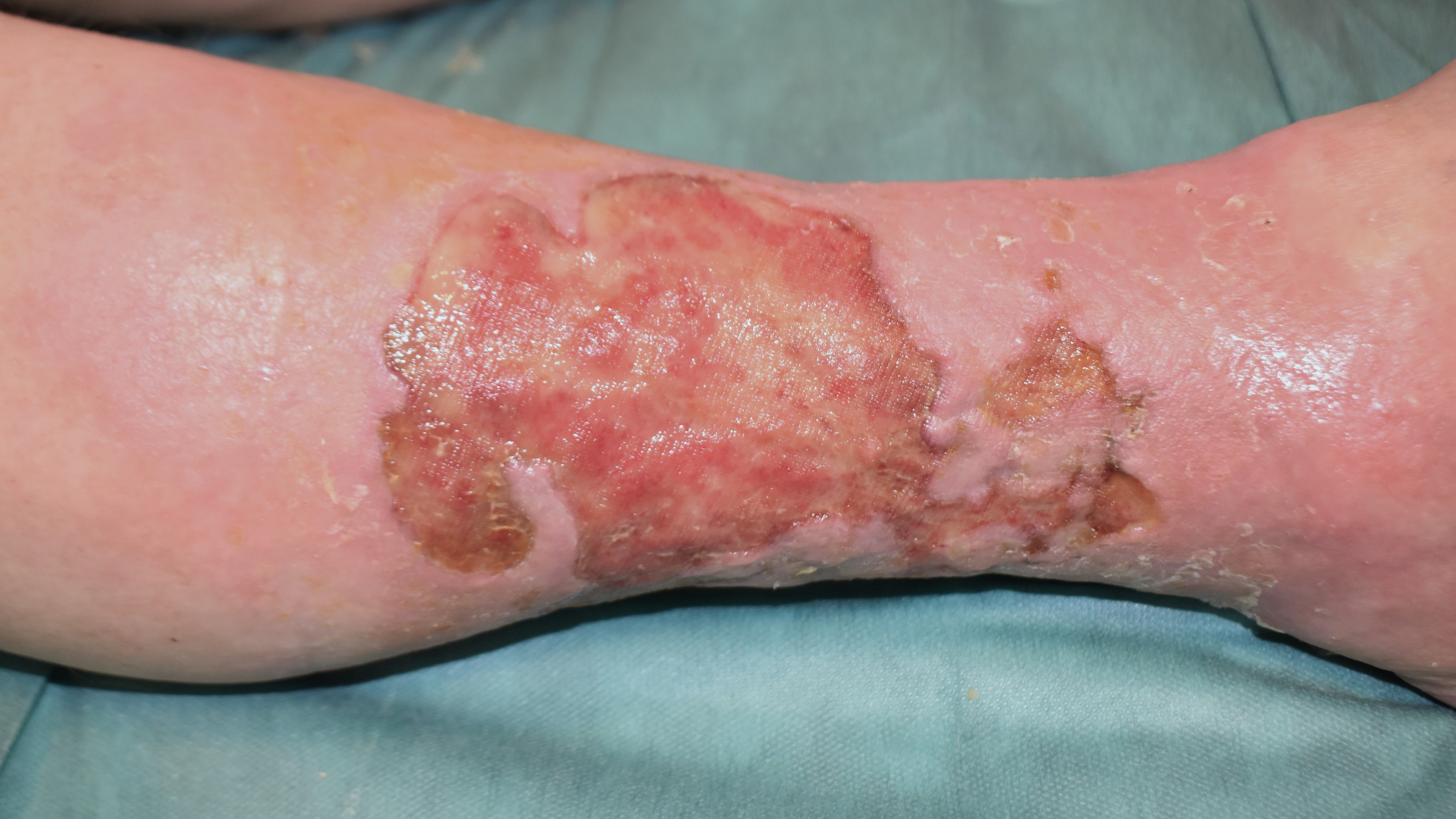 Wundstatus nach 11 Tagen Behandlung mit Biatain Superabsorber