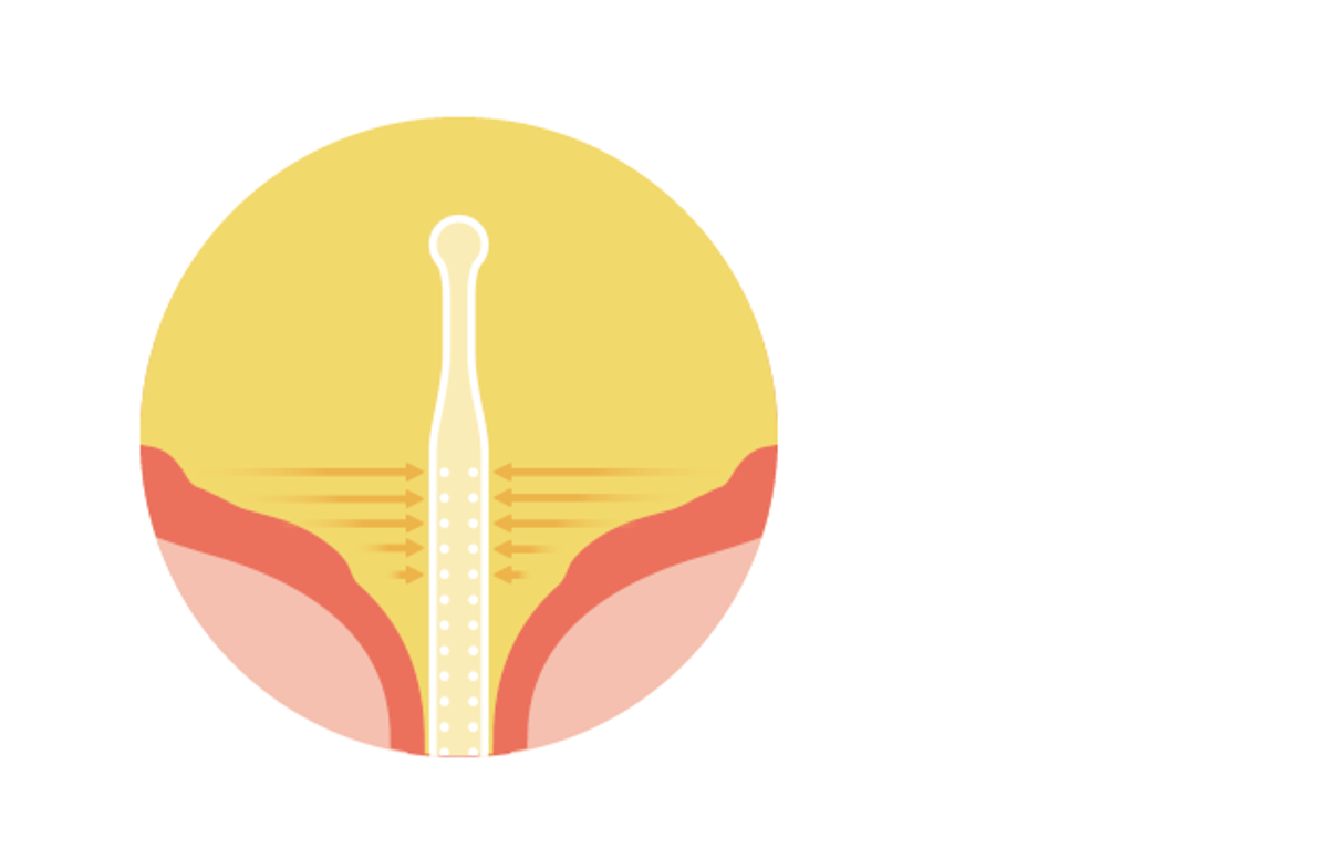 Studienergebnis bestätigt die Vorteile der Micro-hole Zone Technology (MHZT)