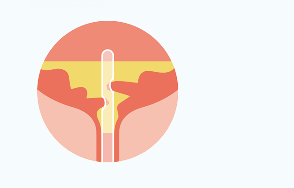 Mögliche Risikofaktoren bei der ISK Anwendung: Restharn und Mikrotraumata