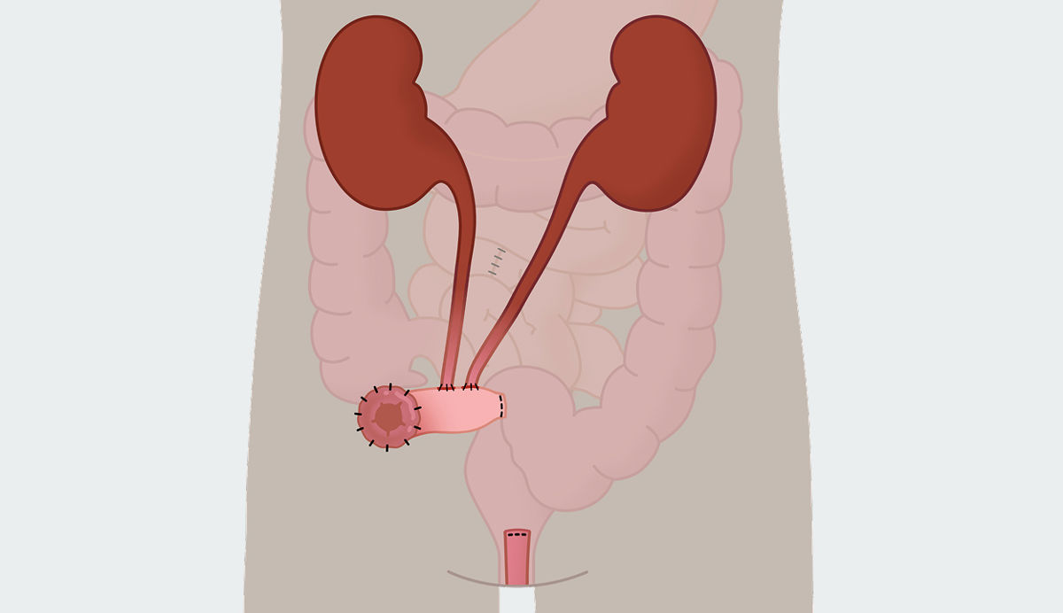 Was ist eine Urostomie?