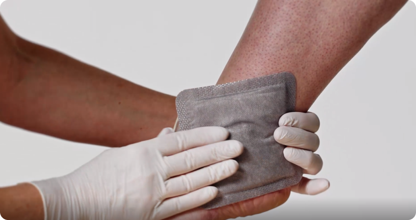 Applikation des Biatain® Superabsorbers - Größe: 7,5cm x 7,5cm