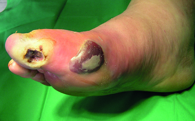 Neuropathie bei einem diabetischen Fuß sensorisch