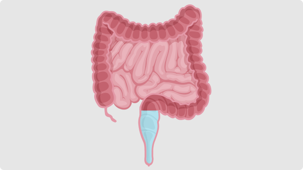 Was ist Transanale Irrigation?
