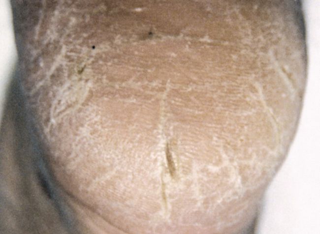 Neuropathie bei einem diabetischen Fuß autonom