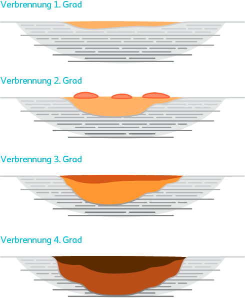 Illustration der vier Verbrennungsgrade: Von oberflächlicher Rötung bis zur tiefen Haut- und Gewebeschädigung.
