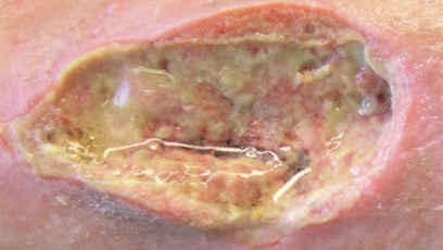 Anwendung Biatain Fiber bei Infektionsrisiko