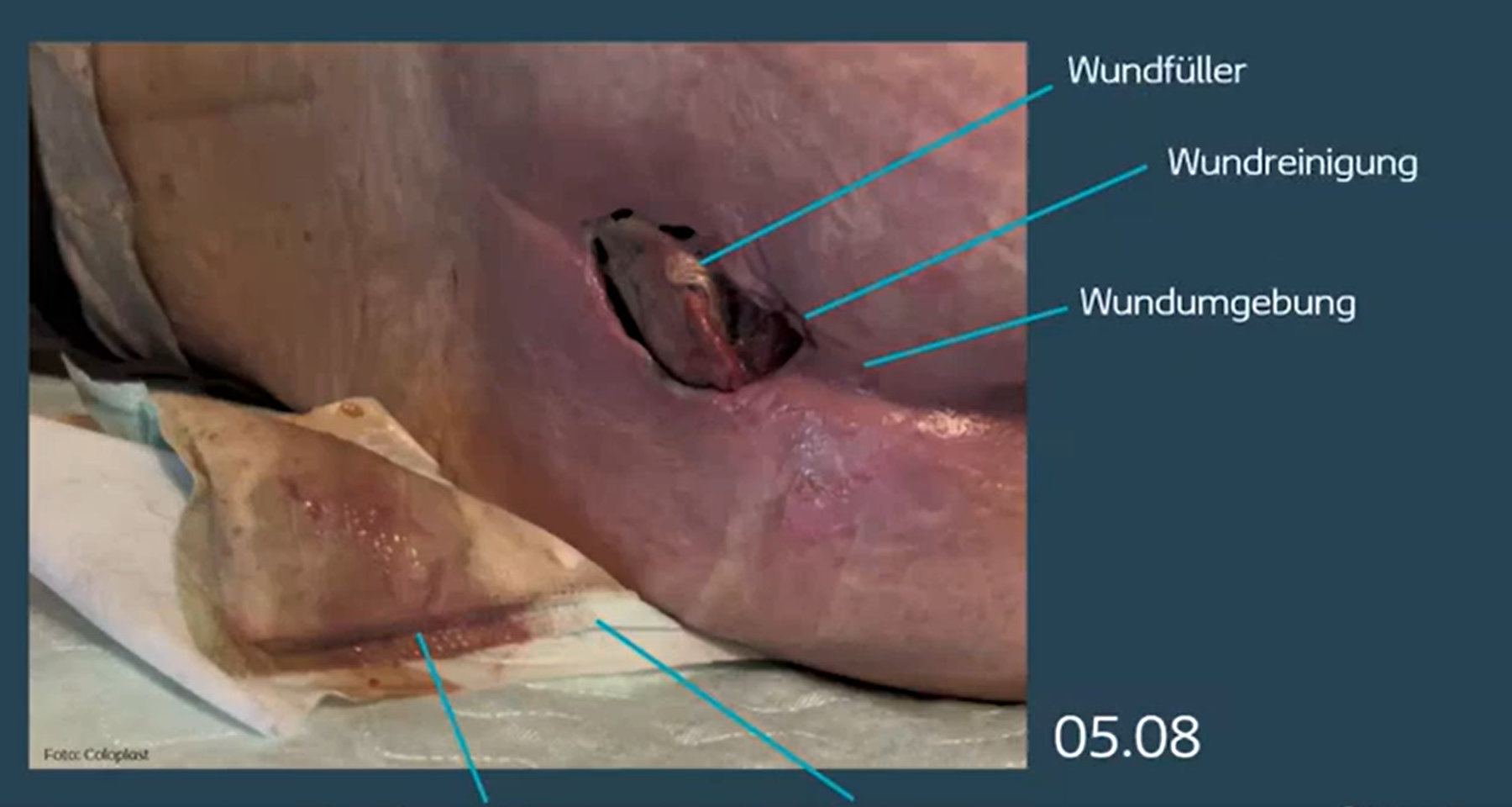 Teaser: Der Faserverband - mehr als nur ein Wundfüller