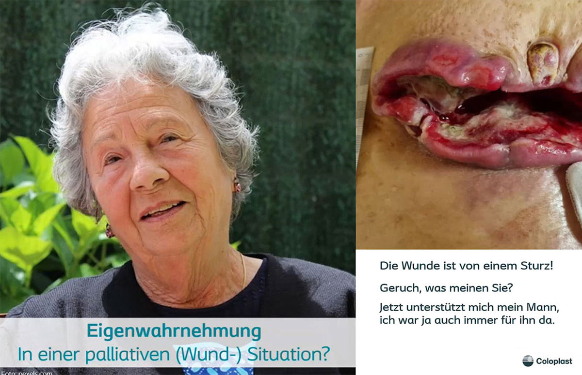 Teaser: Wundversorgung in der Palliativmedizin