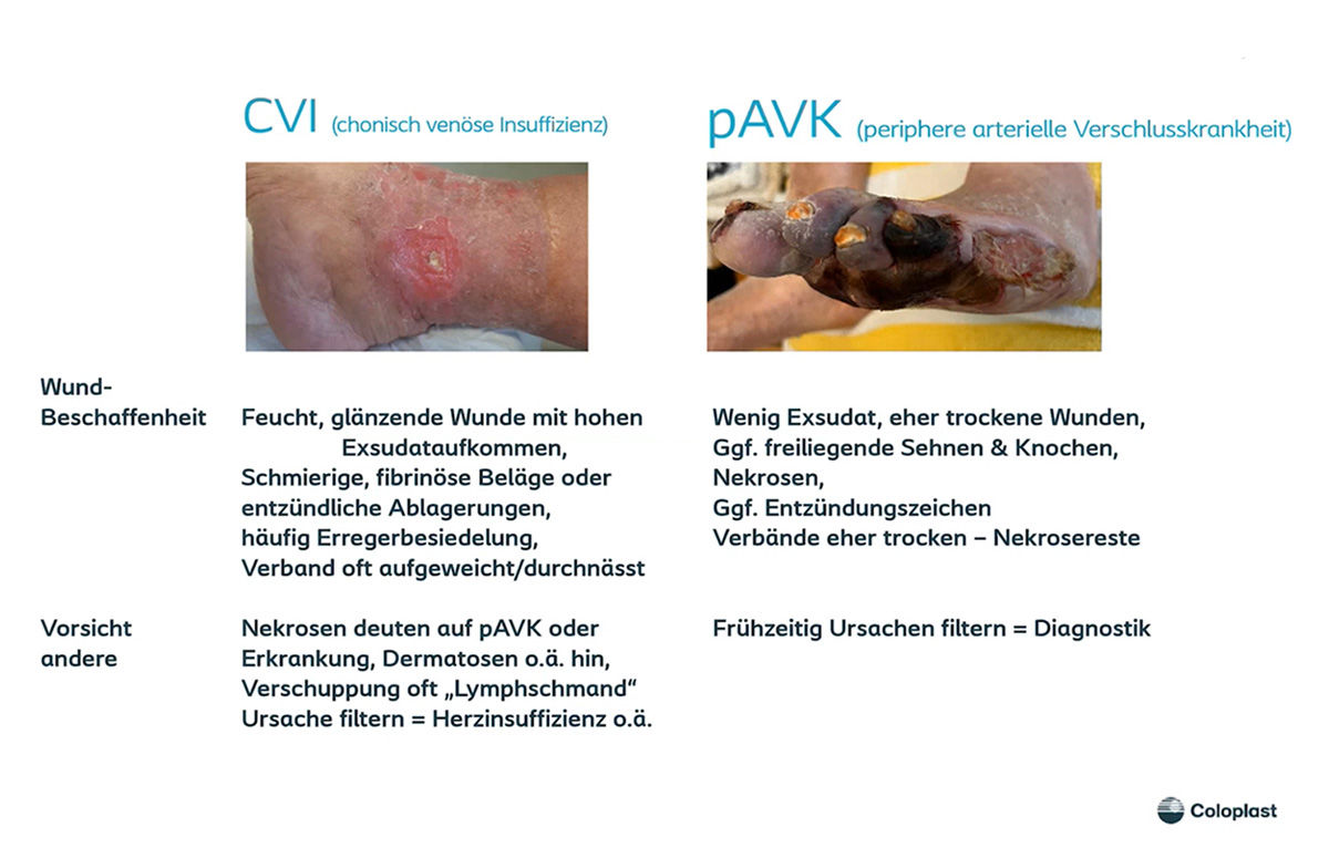 Teaser: Ulcus cruris – Ursachen und Therapie
