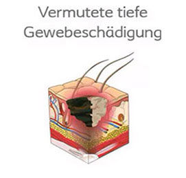 Dekubitus mit vermuteter tiefer Gewebeschädigung: Dunkle, verfärbte Haut oder Blase mit unklarer Tiefe der Nekrose.